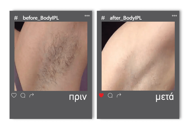 Before_After BodyIpl 3