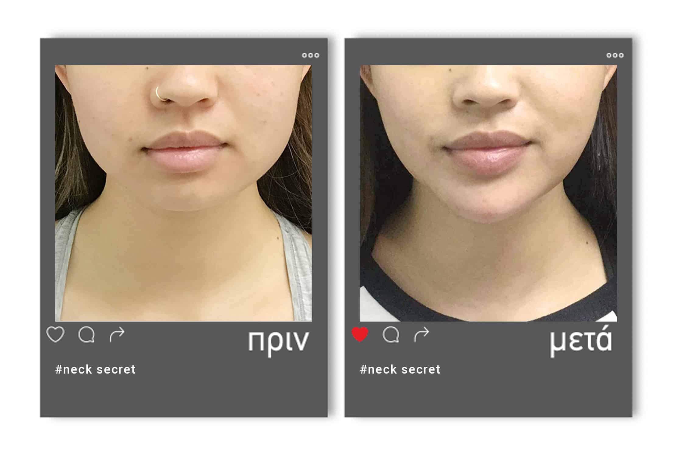 Before-after-neck-secret-2